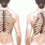 scoliosis in adults